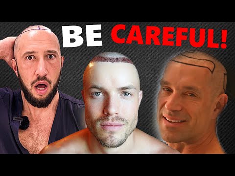 Видео: 4 МИНУСА пересадки волос в Турции за 3000$!!! (низкая стоимость)