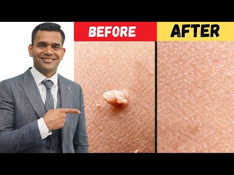 Видео: Удаление папиллом и бородавок за 24 часа — доктор Вивек Джоши