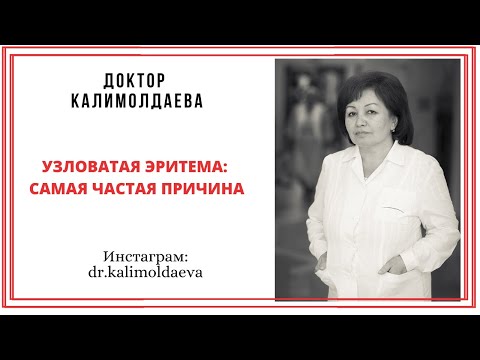 Видео: Узловатая эритема: самая частая причина
