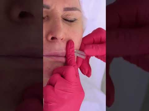 Видео: Нити screw. 3 важных правила имплантации.