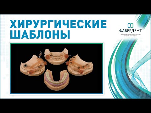 Видео: Навигационные Хирургические шаблоны и Временные реставрации для немедленной нагрузки