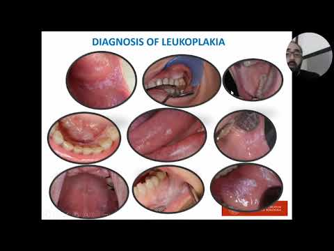 Видео: ПРЕДРАКОВЫЕ СОСТОЯНИЯ СЛИЗИСТОЙ ОБОЛОЧКИ ПОЛОСТИ РТА: Стоматология: клиническая картина