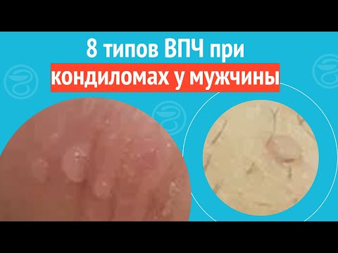 Видео: 8️⃣ 8 типов ВПЧ при кондиломах у мужчины. Клинический случай №1684