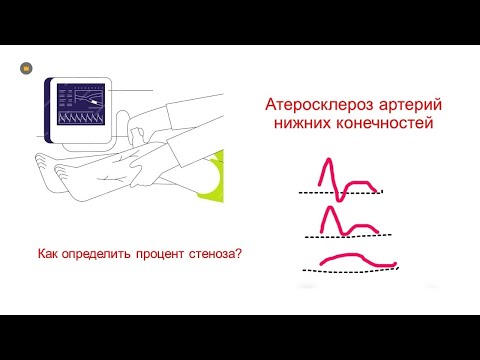 Видео: Определение степени стеноза артерий нижних конечностей на УЗИ.
