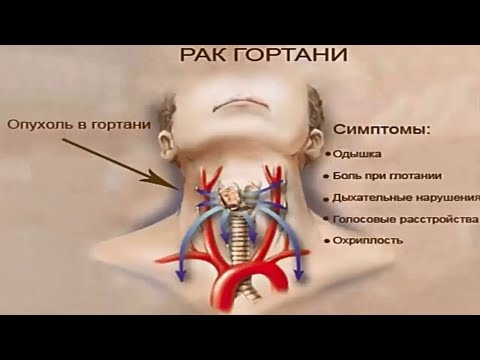 Видео: Рак гортани. Программа "36,6" 12.07.2023