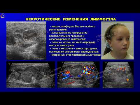 Видео: Отек лица и шеи у детей  Подводные камни ультразвуковой диагностики