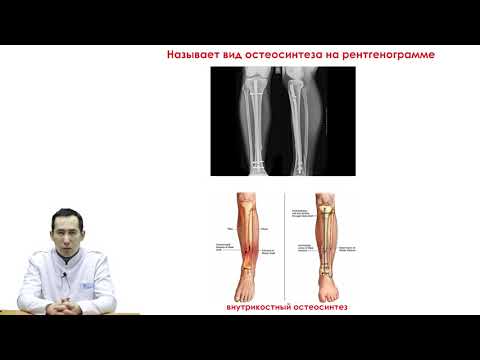 Видео: Переломы диафиза кости конечностей