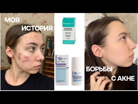 Видео: акне: моя история/эффезел спас мою кожу