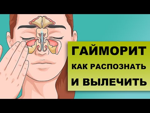 Видео: ГАЙМОРИТ. СИНУСИТЫ. Как диагностировать и лечить