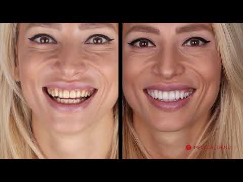 Видео: Smile Design - Поставяне на фасети от д-р Бранимир Кирилов | Medical Dent