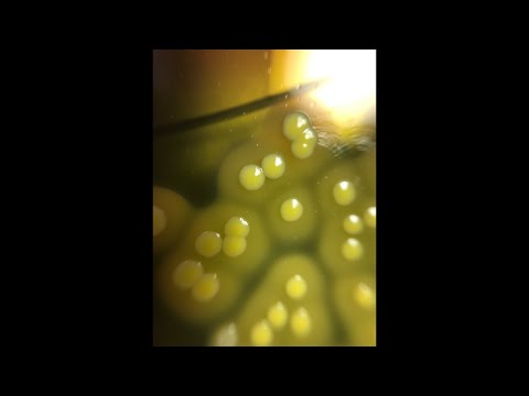 Видео: Бакпосев с трахеостом. Обзор кейсов в прямом эфире