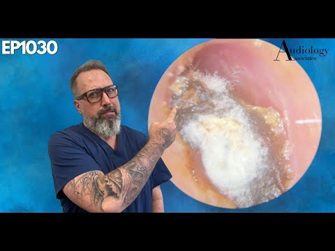 Видео: Глубокое, сухое и трудное удаление ушной серы - EP1030