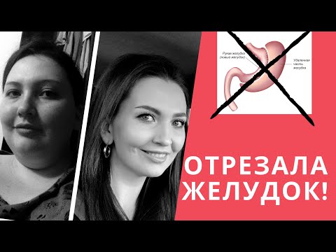 Видео: 5 ЛЕТ ПОСЛЕ РЕЗЕКЦИИ ЖЕЛУДКА | ПОЖАЛЕЛА ЛИ Я | ОТЗЫВ | МОЙ ОПЫТ