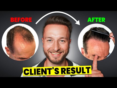 Видео: Пересадка волос в Турции за 7000 долларов! 4011 графтов | Обзор за 9 месяцев