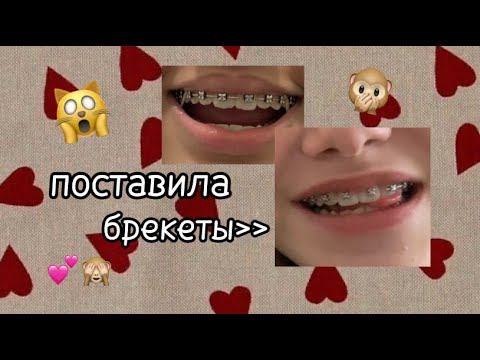 Видео: ПОСТАВИЛА БРЕКЕТЫ🙀| Какие ощущения?🙃| vlog|honey_bear🤍