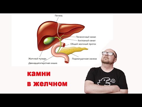 Видео: камни в желчном пузыре