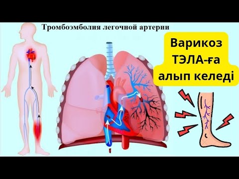 Видео: ТЭЛА деген қандай ауру?/ Тромбоэмболия легочной артерии / Өкпе артериясының тромбоэмболиясы