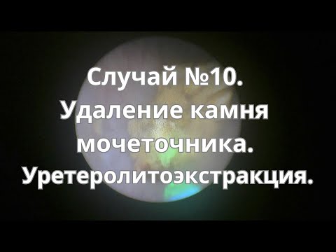 Видео: Случай №10. Лечение камня средней трети мочеточника. Уретеролитоэкстракция.