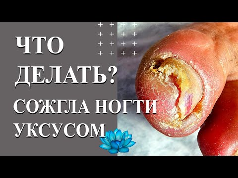 Видео: Микоз кожи. Удаление вросшего ногтя.