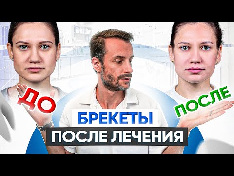 Видео: Лицо ДО и ПОСЛЕ брекетов. Как брекеты меняют лицо?