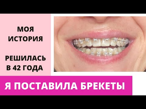 Видео: Я ПОСТАВИЛА БРЕКЕТЫ. МОЯ ИСТОРИЯ.