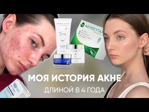 Видео: Как я вылечила АКНЕ? | Моя история лечения акне | Результат|Акнекутан, ретиноиды, уход за кожей.