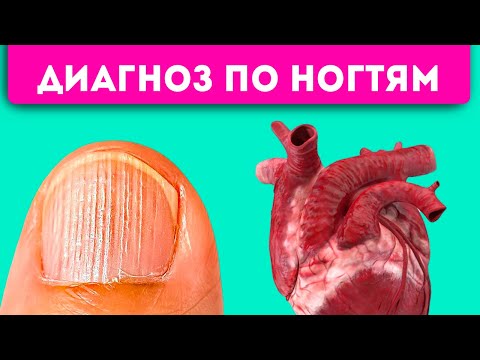 Видео: Маникюр не спасет! 8 проблем с ногтями, которые укажут на сердце, легкие, желудок и даже …