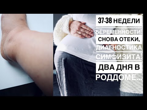 Видео: БЕРЕМЕННОСТЬ 37 - 38 НЕДЕЛИ | ДВА ДНЯ В РОДДОМЕ | ДИАГНОСТИКА СИМФИЗИТА | СНОВА ОТЕКИ | СТИМУЛЯЦИЯ..