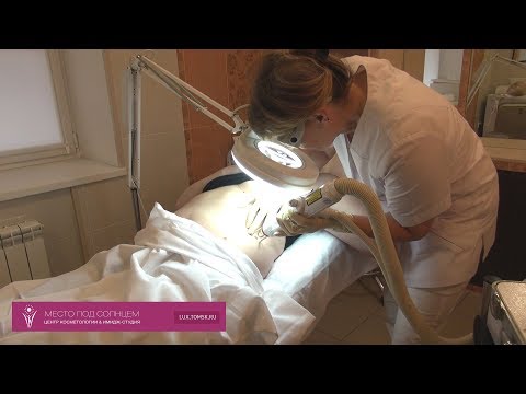 Видео: Удаление кератом