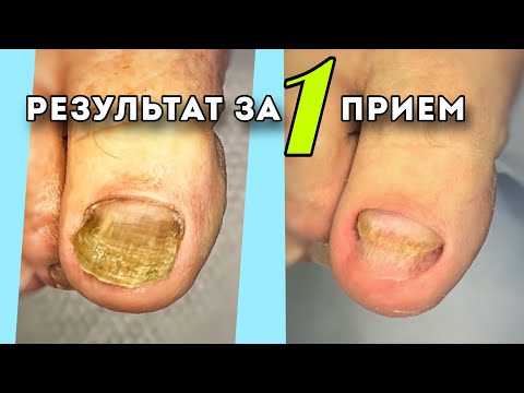 Видео: Как правильно зачистить грибок на ногте. Убрать давление, боль в синусовых углах #подологтатьянапак