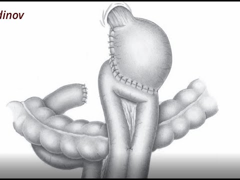 Видео: Гастроеюностомия  Бильрот 2 Ахмадудинов А.М.