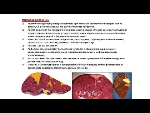 Видео: УЗИ. Доктор Иогансен. Выпуск 64. Неопухолевые очаговые изменения селезенки. Часть 2.