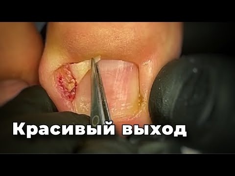 Видео: Наблюдалась у подолога по совместительству парикмахер. Грануляцию определила как грибок ногтей