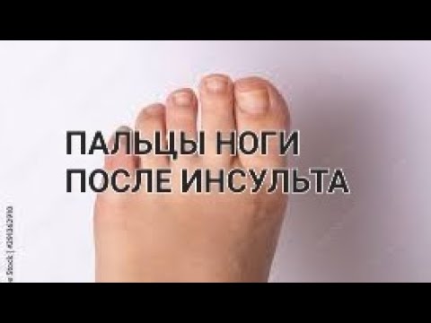 Видео: ВОССТОНОВЛЕНИЕ ПАЛЬЦЕВ НОГИ ПОСЛЕ ИНСУЛЬТА