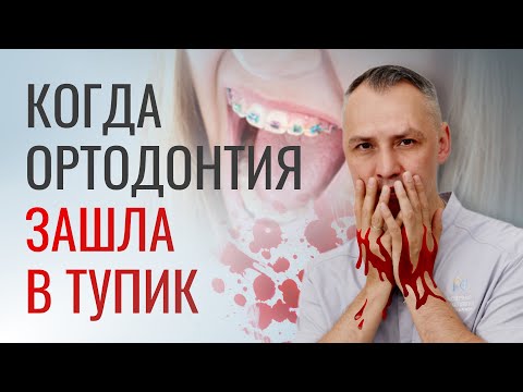 Видео: КОГДА ОРТОДОНТИЯ ЗАШЛА В ТУПИК