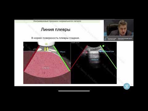 Видео: Ультразвук лёгких в условиях ОРИТ. Лахин Роман Евгеньевич.