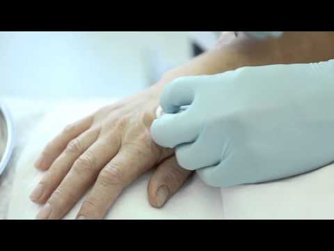 Видео: Канюльная биоревитализация кистей рук препаратом ReNova Vita Skin