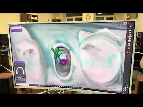 Видео: Изготовление культовой вкладки в программе ExoCad