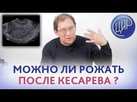 Видео: Рубец после кесарева. Естественные роды после кесарева сечения - да или нет- как определить?