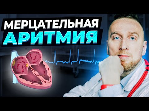 Видео: Мерцательная аритмия. Фибрилляция предсердий с @DoctorUtin