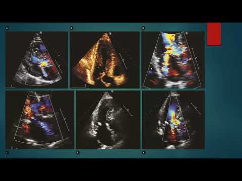 Видео: Пак Наталья Лероновна "Эхокардиография. Гипертрофия левого желудочка" (19.02.2024г)