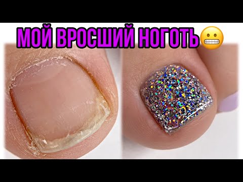 Видео: Мои жуткие ногти😱Вросший ноготь😕Педикюр в домашних условиях