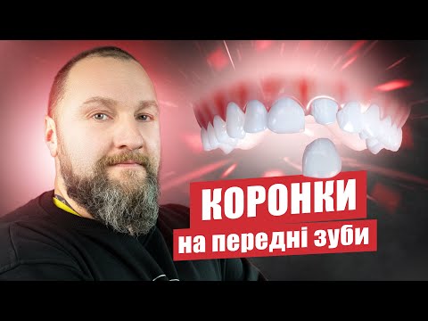 Видео: 🇺🇦 Коронки на передние зубы — какие лучше поставить?