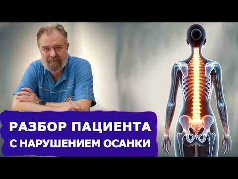 Видео: Как исправить осанку за 1 прием? Разбор пациента со сколиозом