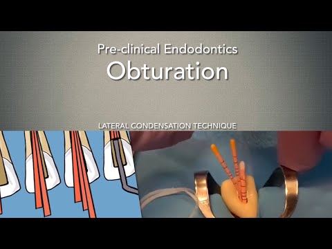 Видео: Обтурация (метод латеральной конденсации)