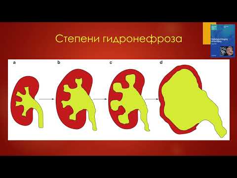 Видео: Расширение ЧЛС. УЗ-диагностика. Ультразвук в руках уролога - 2022.