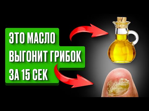 Видео: Как я навсегда избавилась от ГРИБКА НОГТЕЙ простым… за 15 сек? Это МАСЛО есть у каждого
