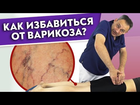 Видео: Как убрать ВАРИКОЗ? | Варикозное расширение вен — причины и лечение