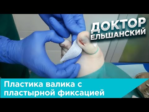 Видео: Пластика валика с пластырной фиксацией при вросшем ногте + перевязка