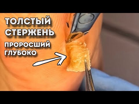 Видео: Жесткий и толстый корень у мозоли глубоко в мягких тканях плюсны стопы